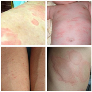 蕁麻疹的癥狀是怎么樣的？