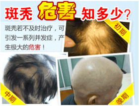 哪些因素導(dǎo)致斑禿？